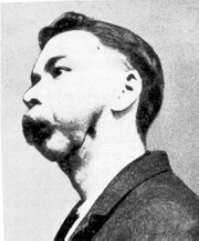 Phossy jaw